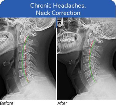 Neuropathy Treatment Plano TX Chronic Headaches Neuropathy Treatment Plano TX Chronic Headaches
