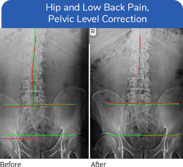 Neuropathy Treatment Plano TX Low Back And Hip Pain Neuropathy Treatment Plano TX Low Back And Hip Pain