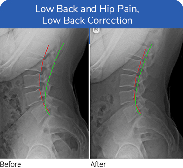 Neuropathy Treatment Plano TX Low Back And Hip Neuropathy Treatment Plano TX Low Back And Hip